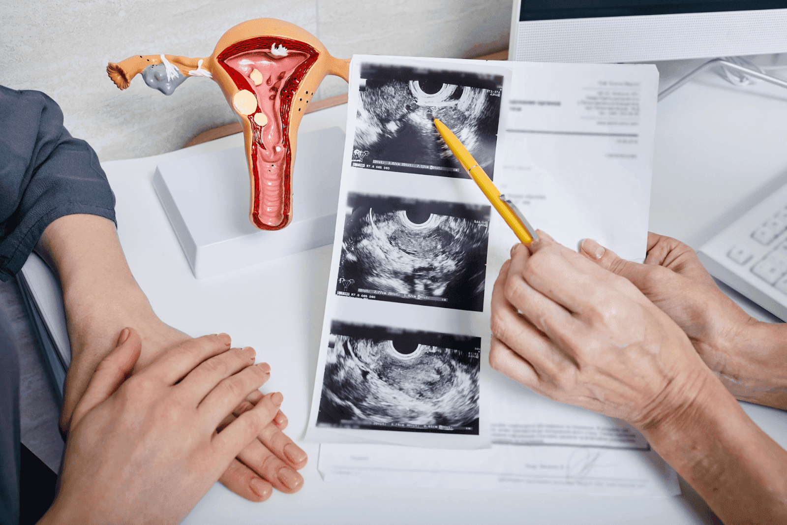 A gynecologist discusses ultrasound images beside a model of the uterus and ovaries, related to PCOS evaluation.