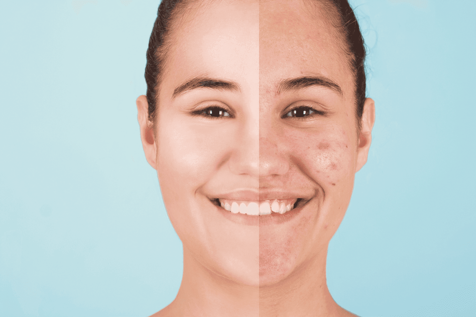 A woman smiling with her face shown in a split comparison: one side clear and smooth, the other side with acne and redness