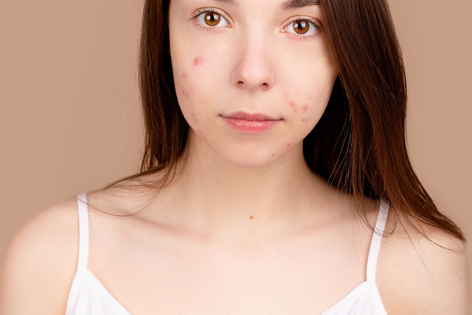 A young woman with red acne spots on her cheeks and forehead, looking at the camera.