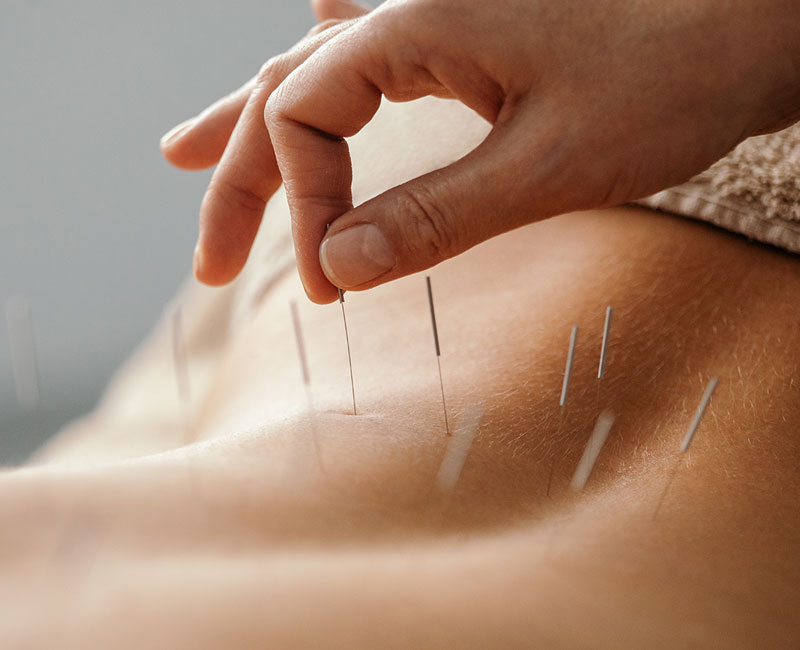Close-up of a person getting acupuncture