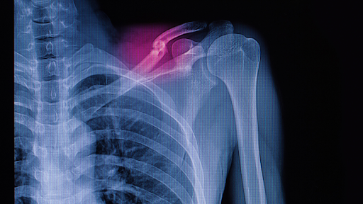 Xray of broken bone on left shoulder area