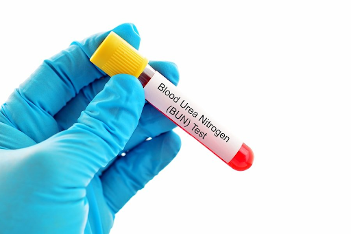 blood sample for BUN level test