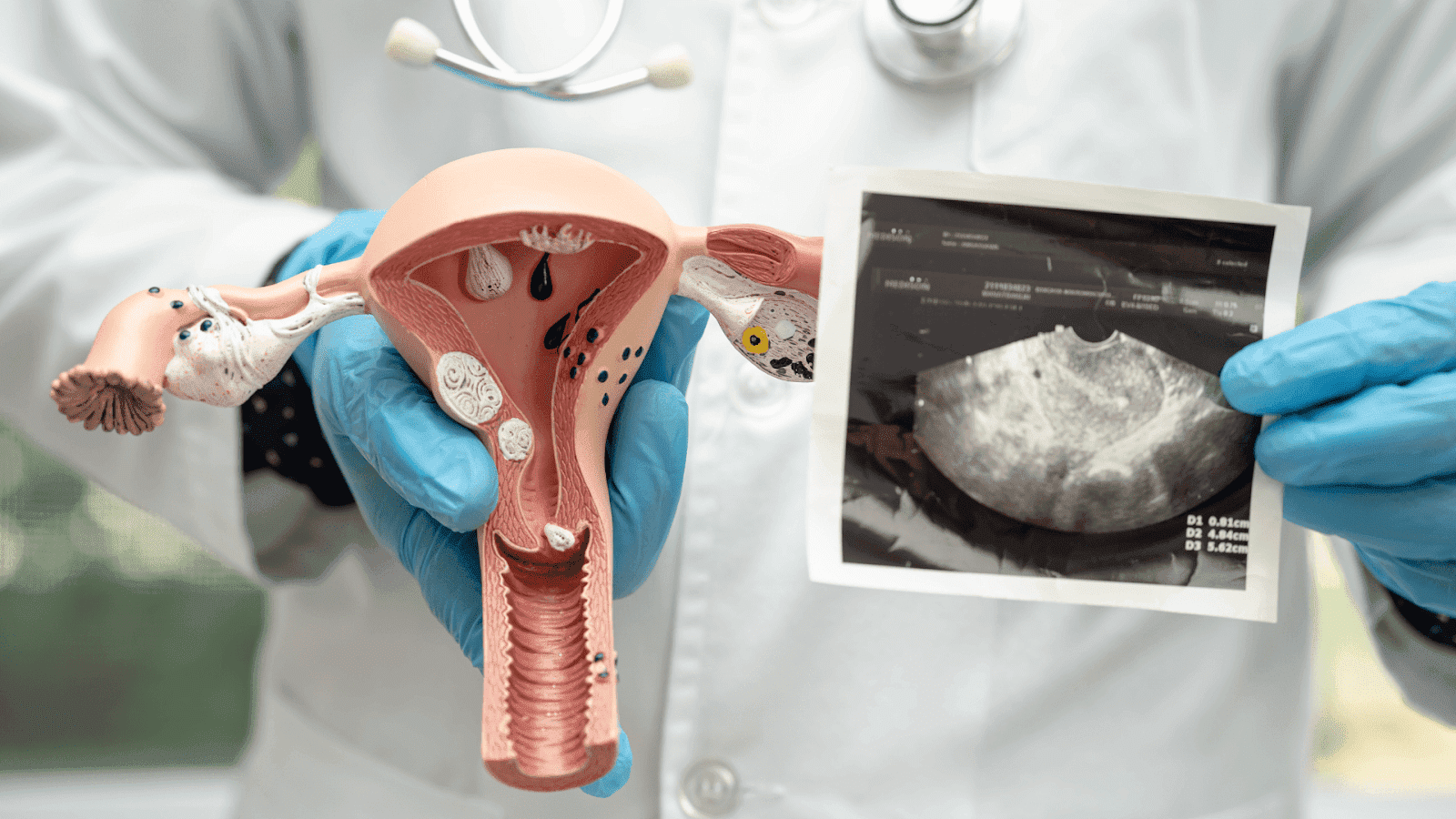 Close-up of a doctor holding a uterus model and an ultrasound image