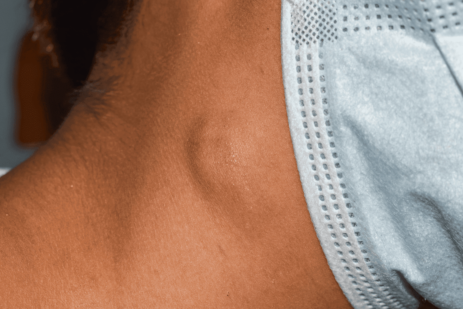 Close-up of a person’s neck showing a swollen lymph node or lump beneath the skin near the jawline, next to a blue face mask.