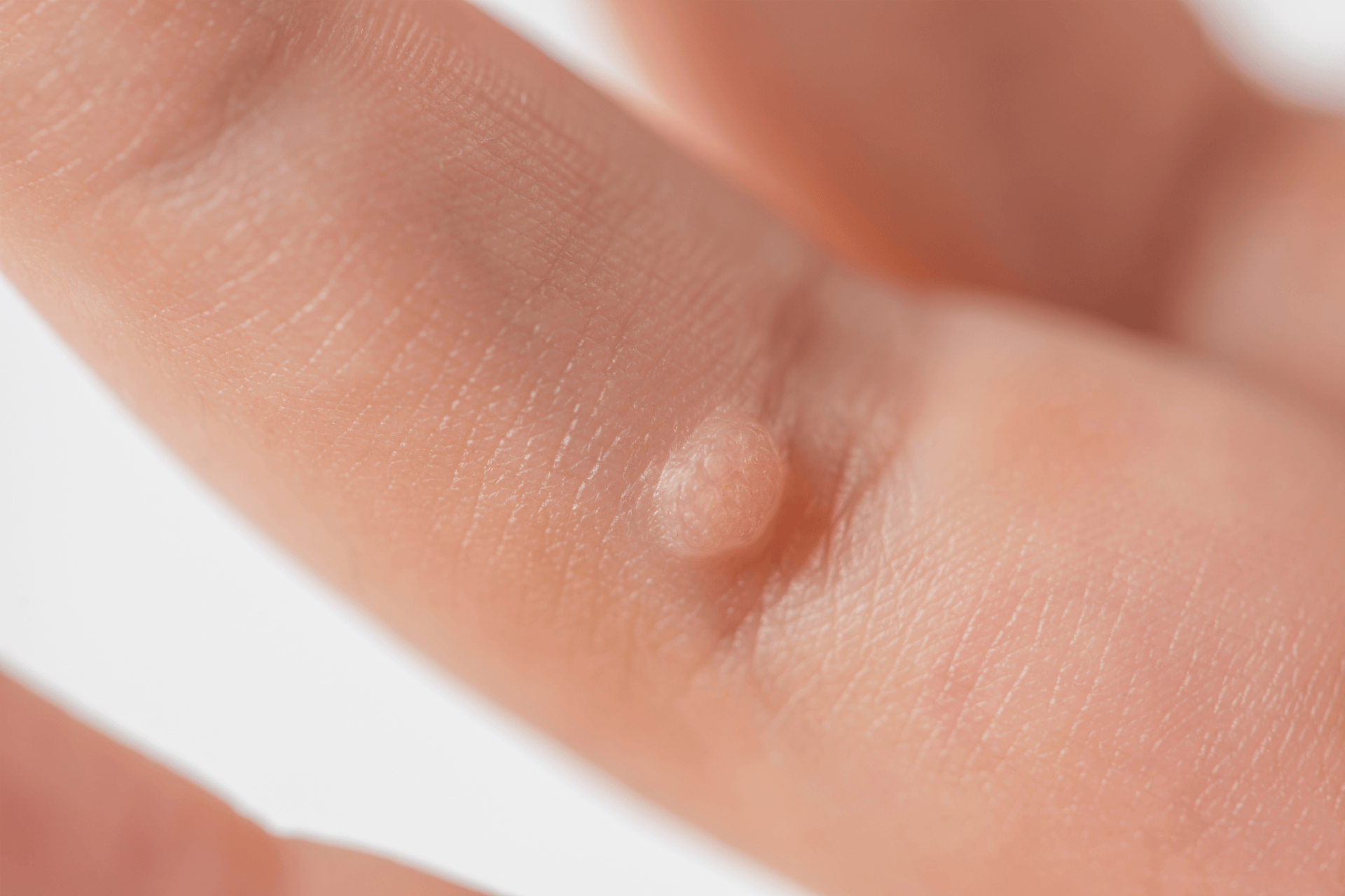 Close-up of a small wart on a finger.