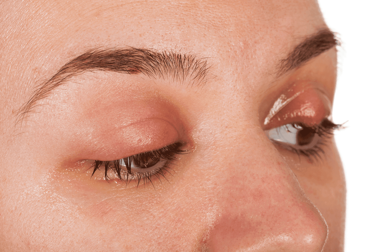 Close-up of a swollen upper eyelid with redness, showing an eye infection