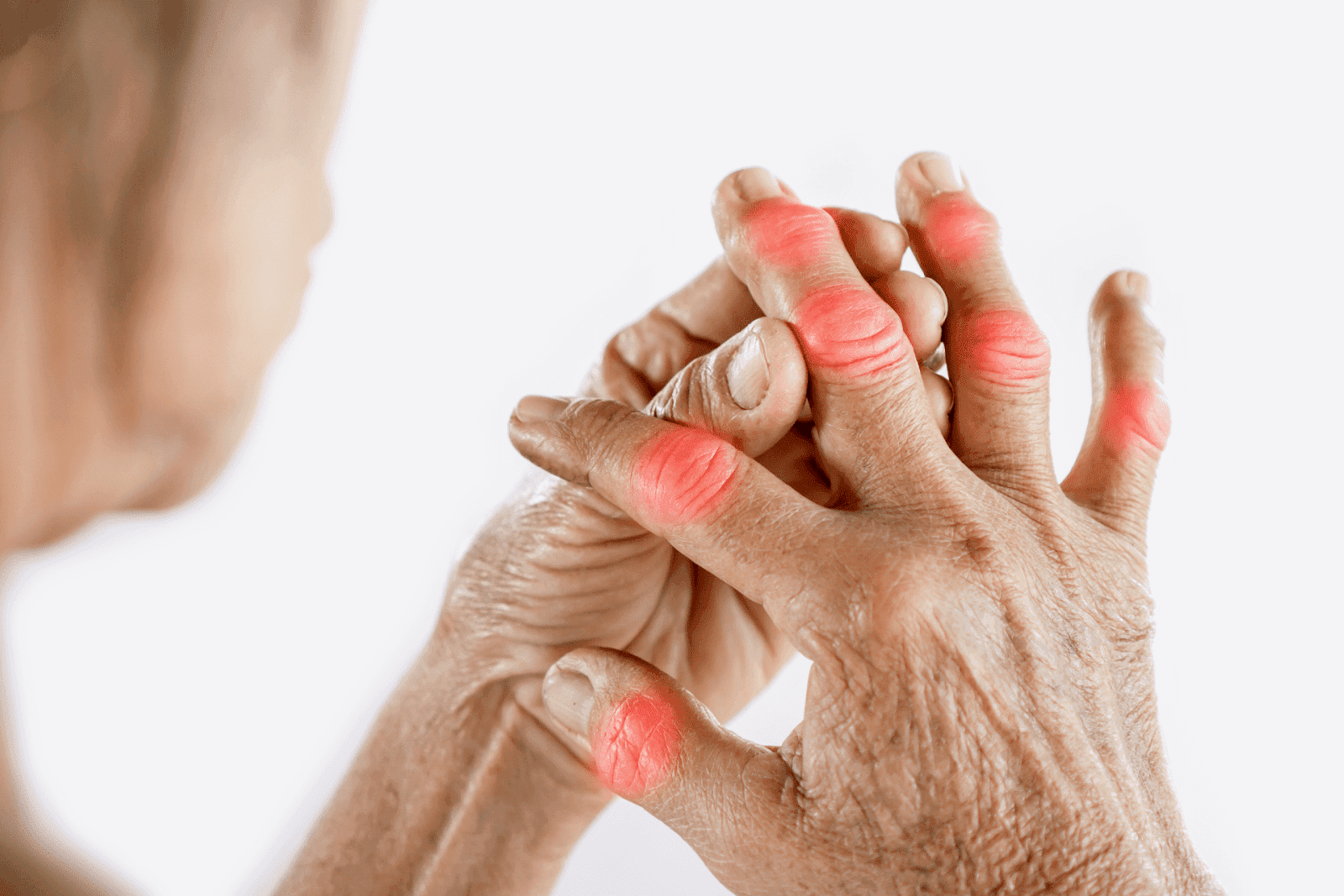Close-up of arthritic hands with red swollen joints