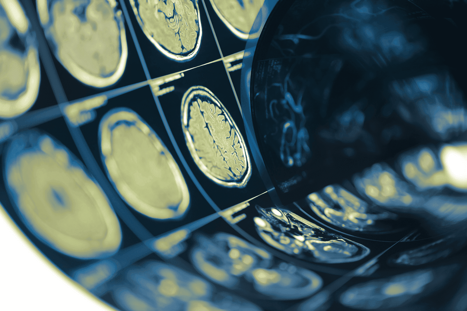 Close-up of brain MRI images on film.