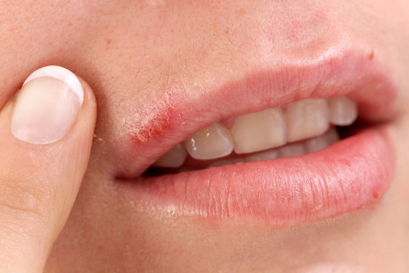 image of a cold sore on the corner of the upper lip