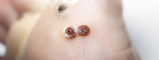 Wound on feet after removal of corns