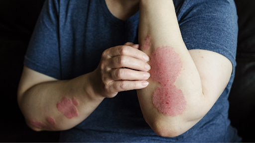 Woman with eczema on arms and itching her left arm