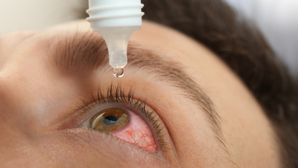 Man putting eye drop into left eye with pink eye.