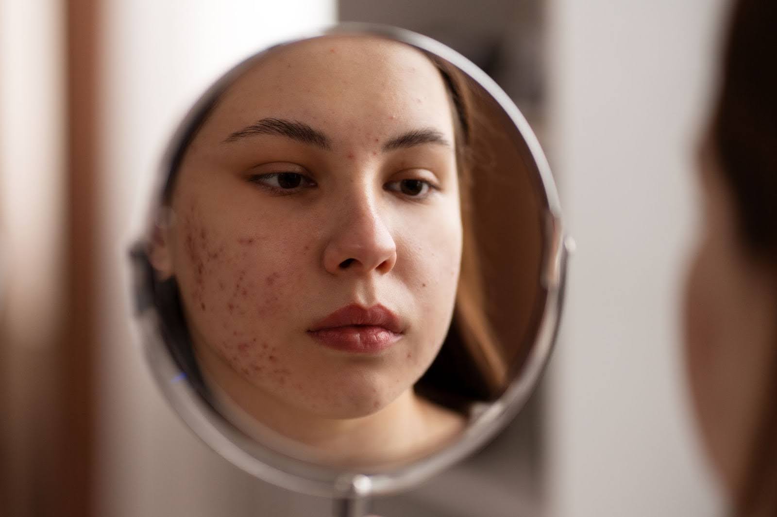 Girl with Skin Condition looking in the mirror