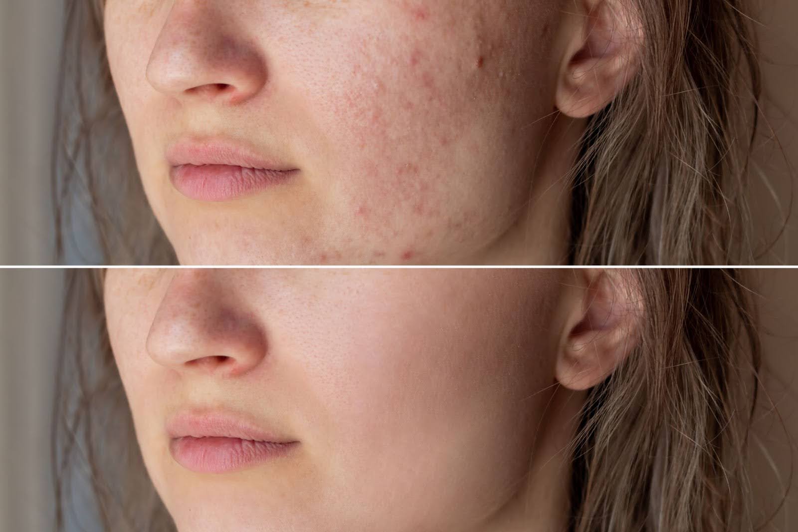 Before and After of a Face with Acne