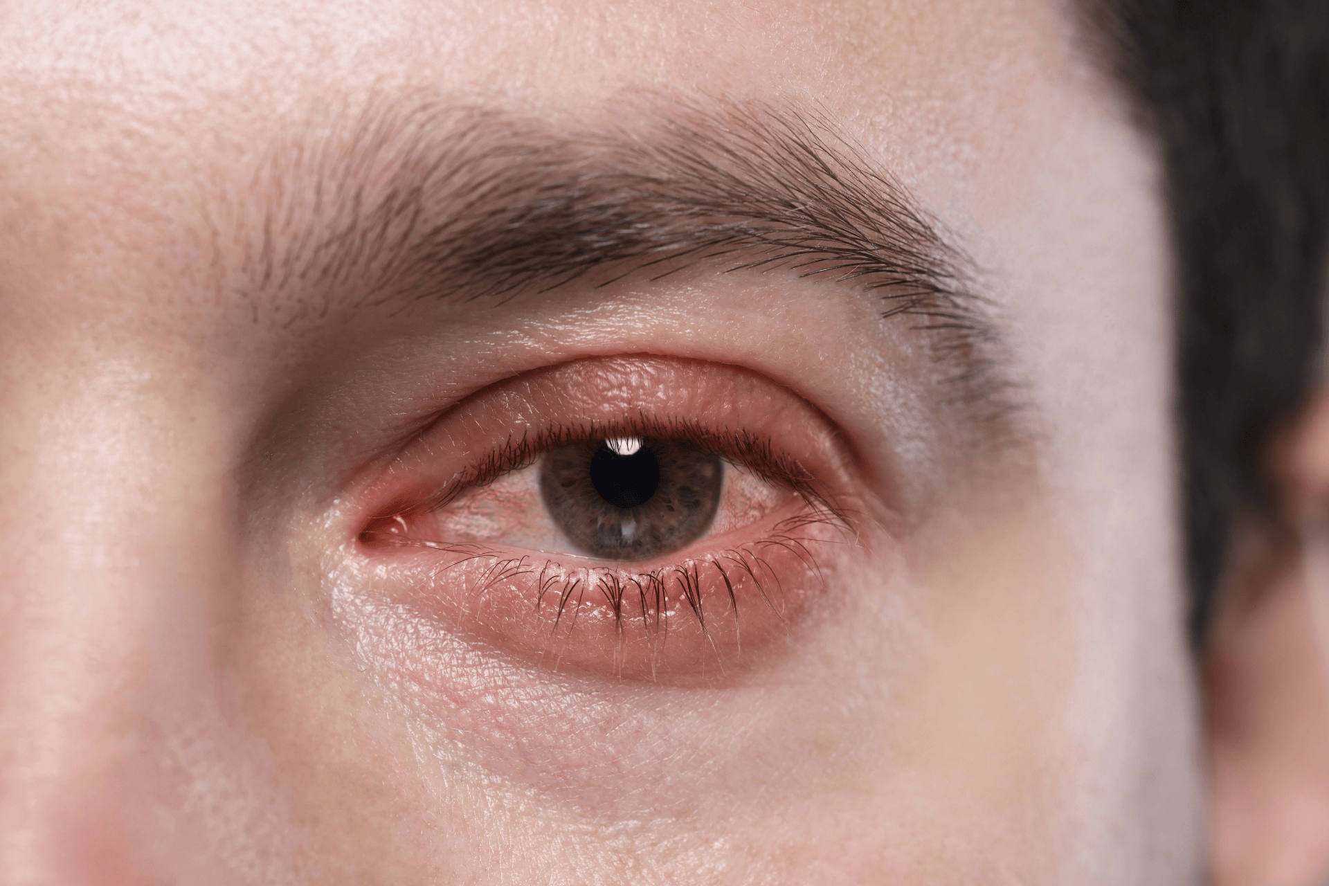 Close-up of a red, irritated eye.