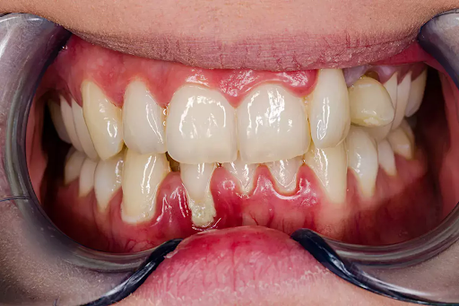 close-up image of what gingivitis looks like
