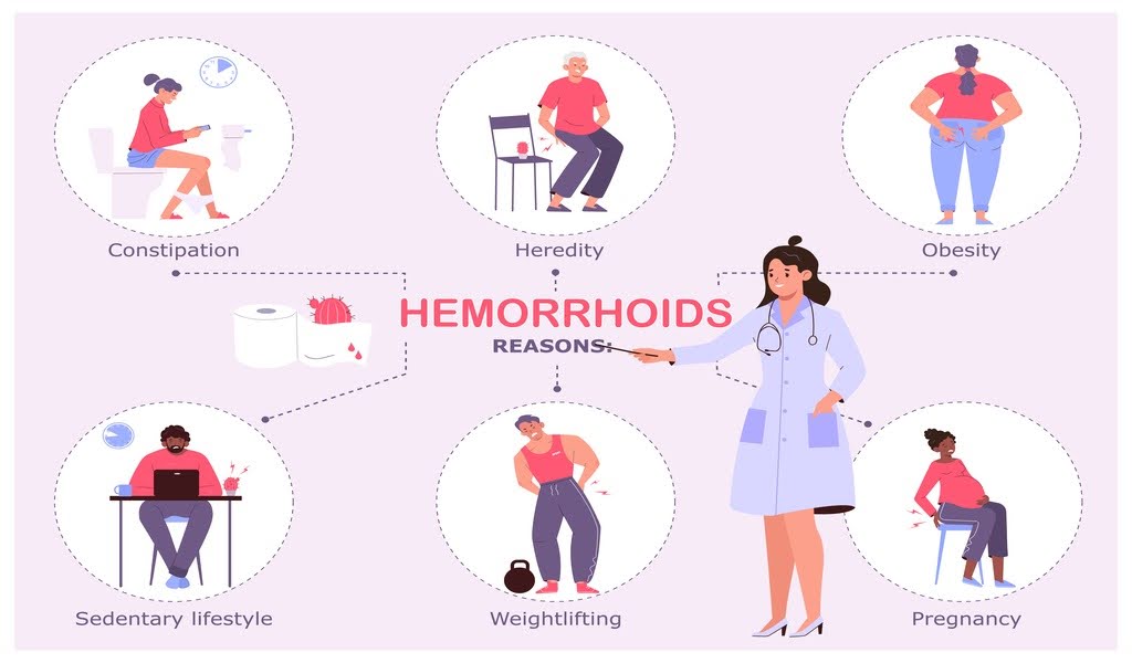 This illustration shows the reason for hemorrhoids