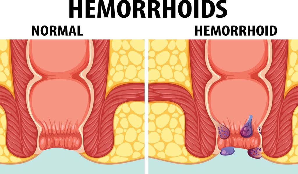 Graphic comparison of a normal anus with one affected by hemorrhoids