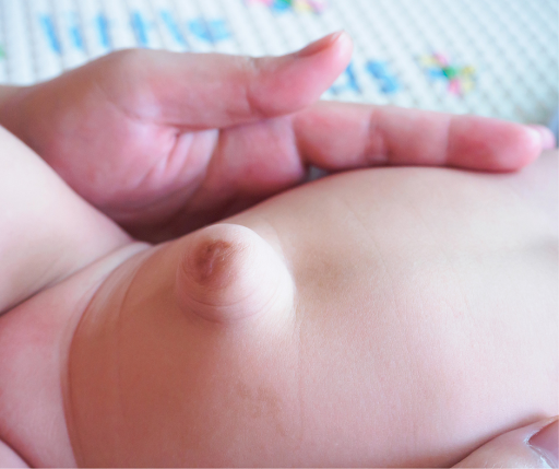 Hands holding an infant with umbilical hernia