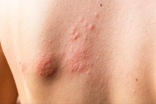 Herpes on Skin