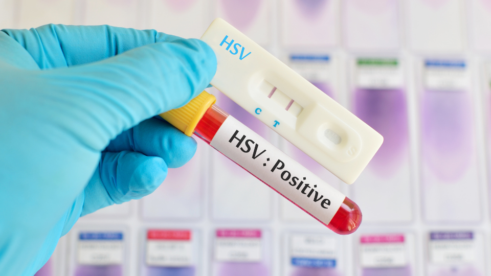 Test showing HSV postitive result