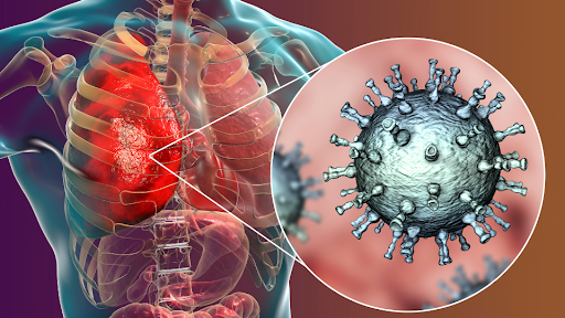 Illustration of pneumonia associated to impacting the lungs