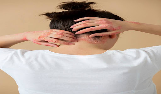 A close-up of red, inflamed folliculitis rashes on a woman’s body.