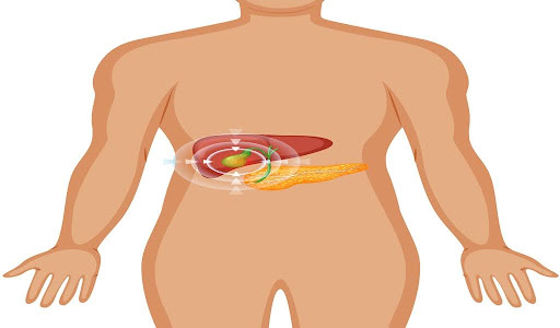 Anatomy image pointing to gallstone formation in the gallbladder.