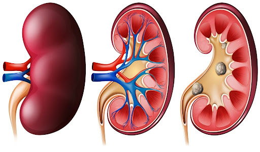 Anatomical illustration of a kidney with visible kidney stones.