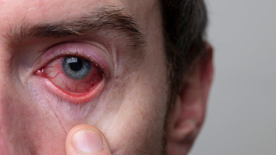 Man showing left eye with pink eye.