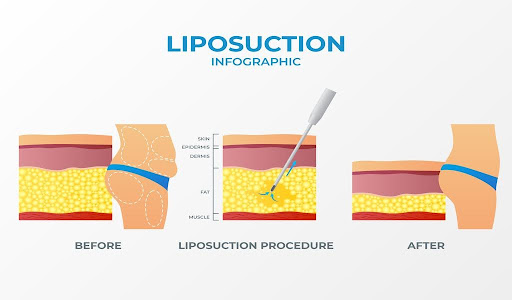 Infographic explaining how liposuction effectively treats lymphedema.