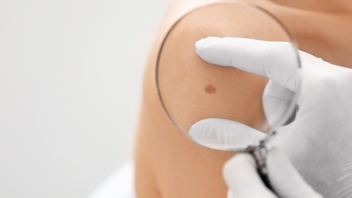 Magnifying glass over a spot on skin