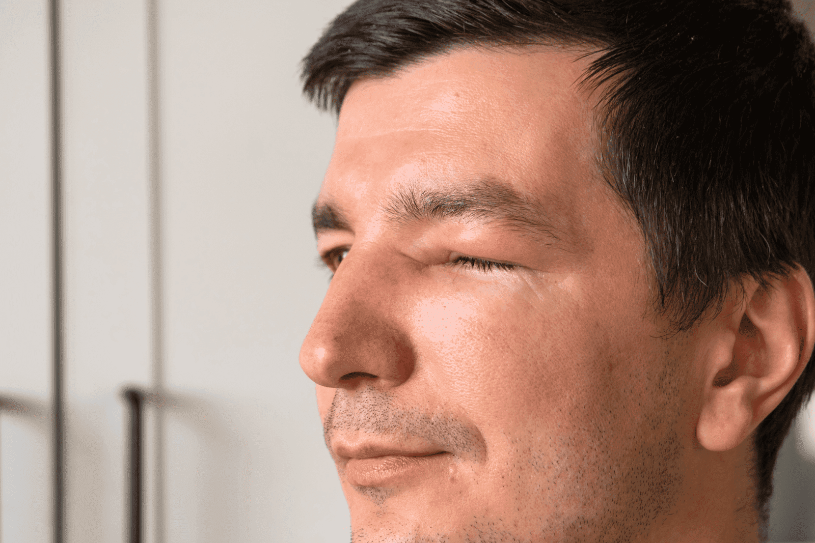 Man with a swollen and red eyelid, squinting in discomfort