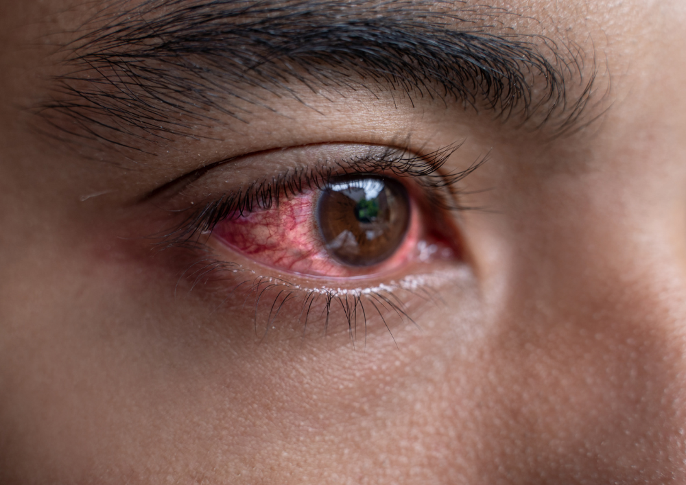 Person showing pink eye symptoms