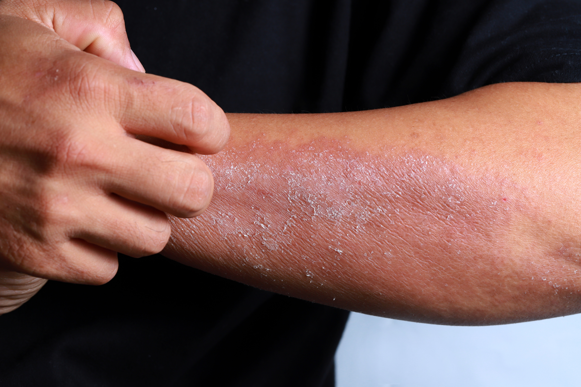Person scratching a dry, scaly rash on their forearm
