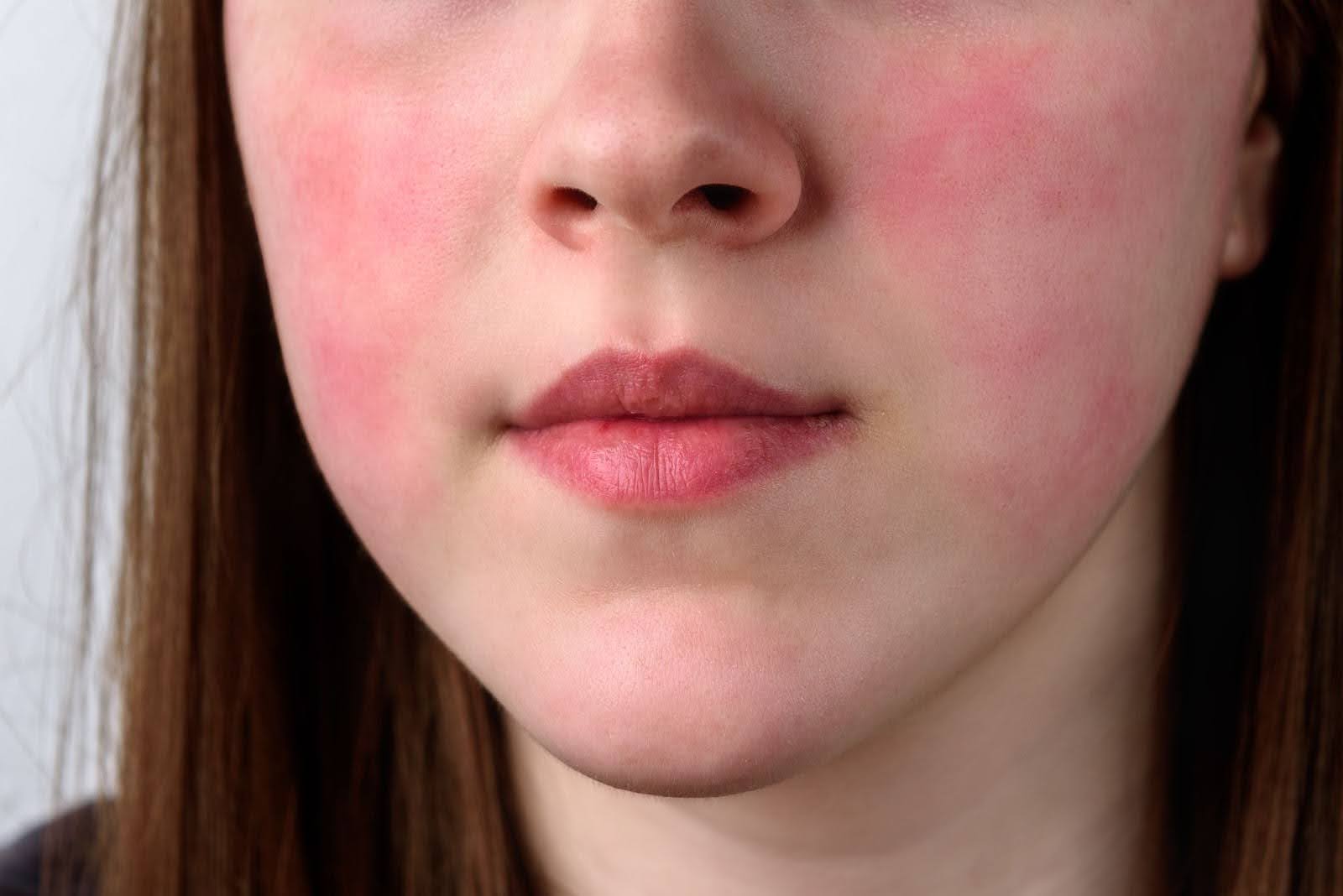 Woman with rashes on her face