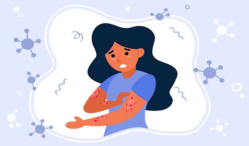 A girl's hand shows red, inflamed skin patches in this illustration