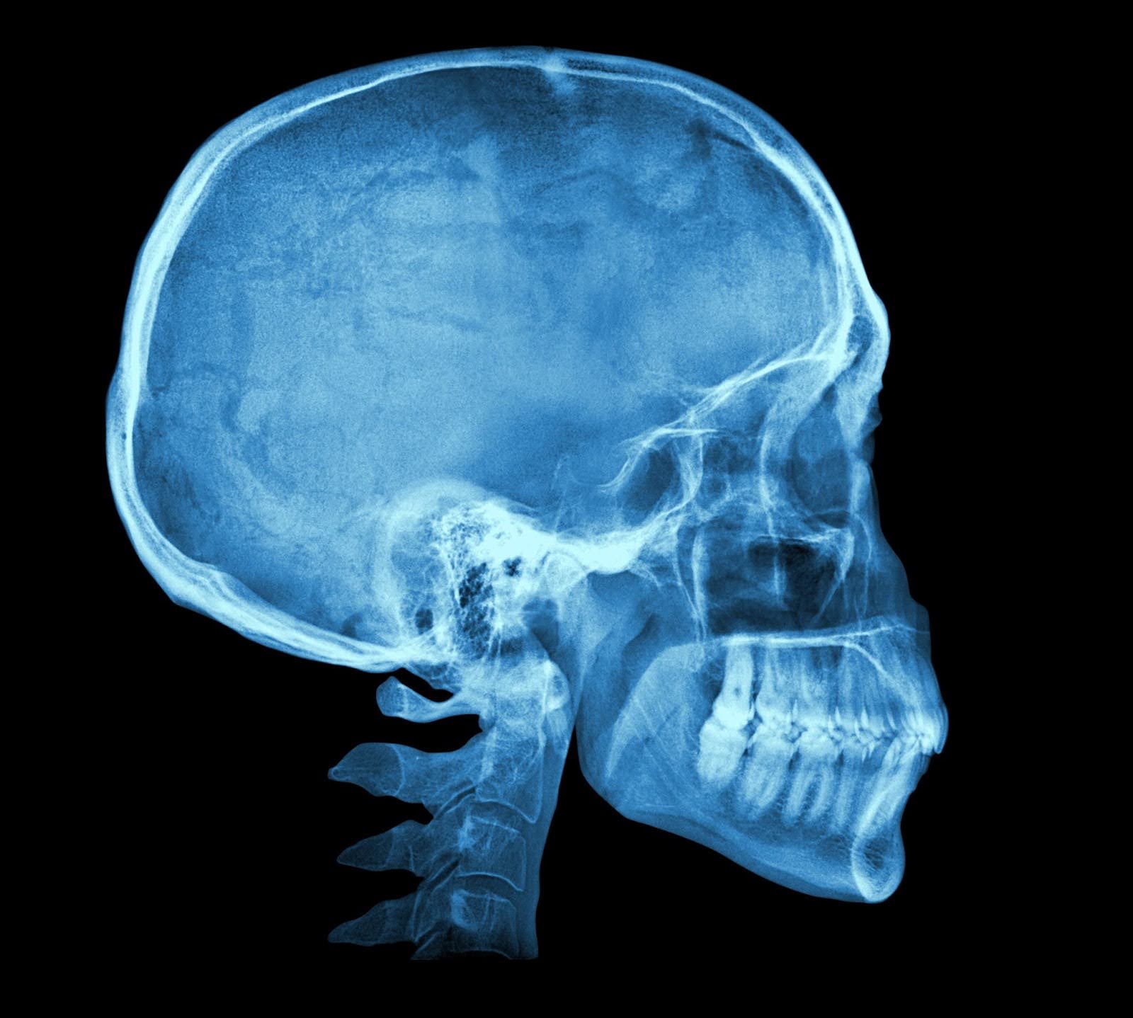 Brain X-ray