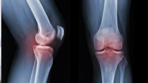 X-Ray of a knee