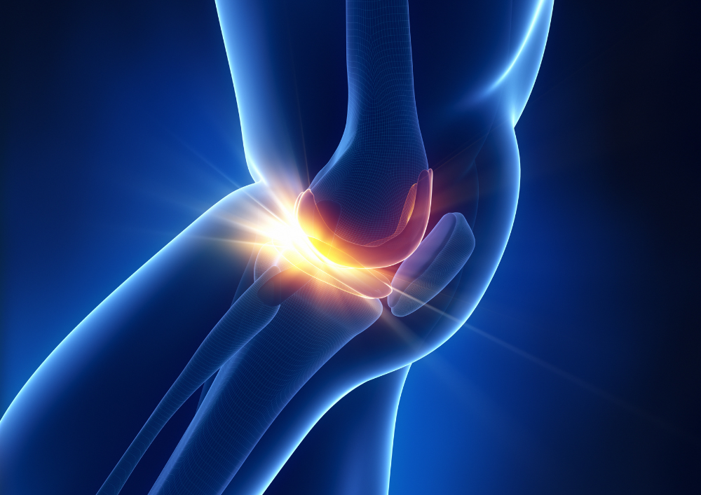 Illustration of the anatomy of a knee with an inflamed meniscus