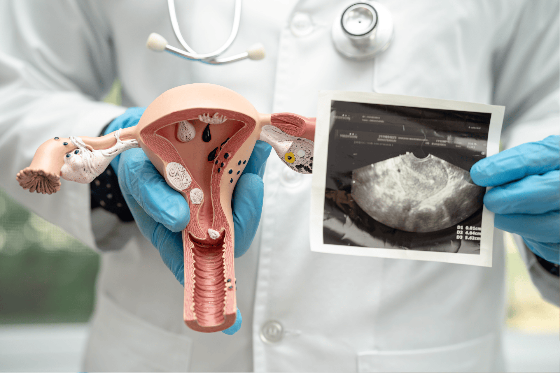 Doctor holding a female reproductive system model and an ultrasound image.