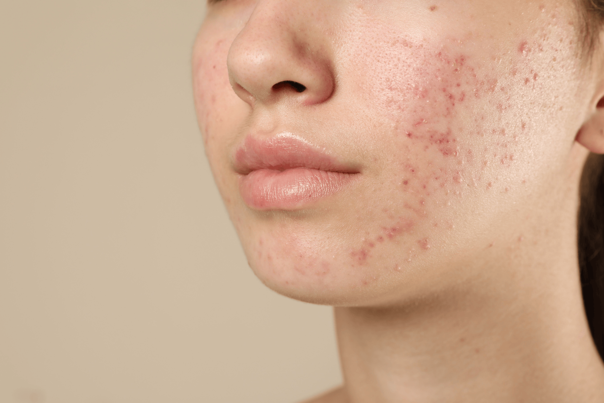 Close-up of a woman with inflamed acne on her cheek and chin