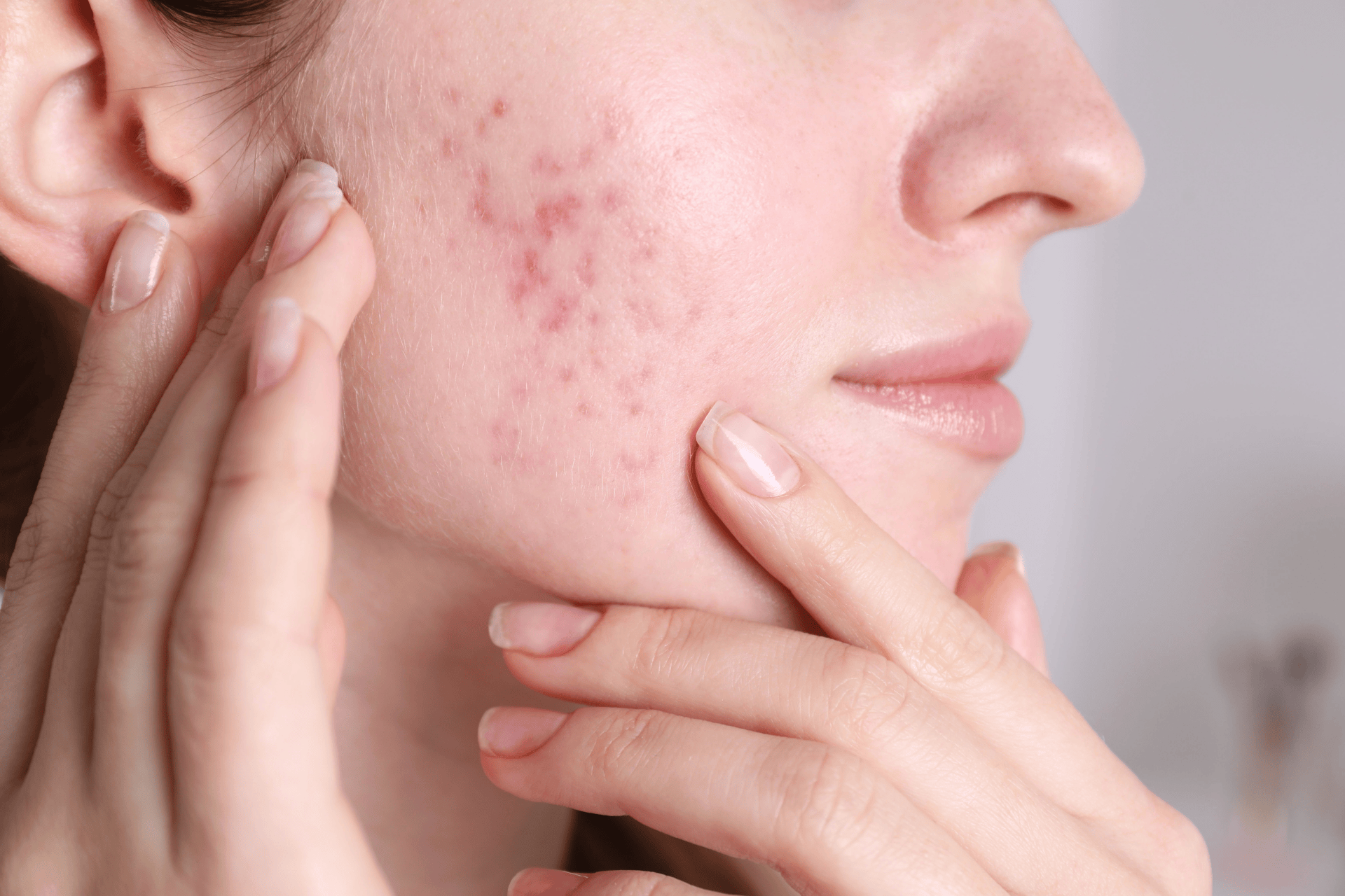 Close-up of a woman touching red acne spots on her cheek