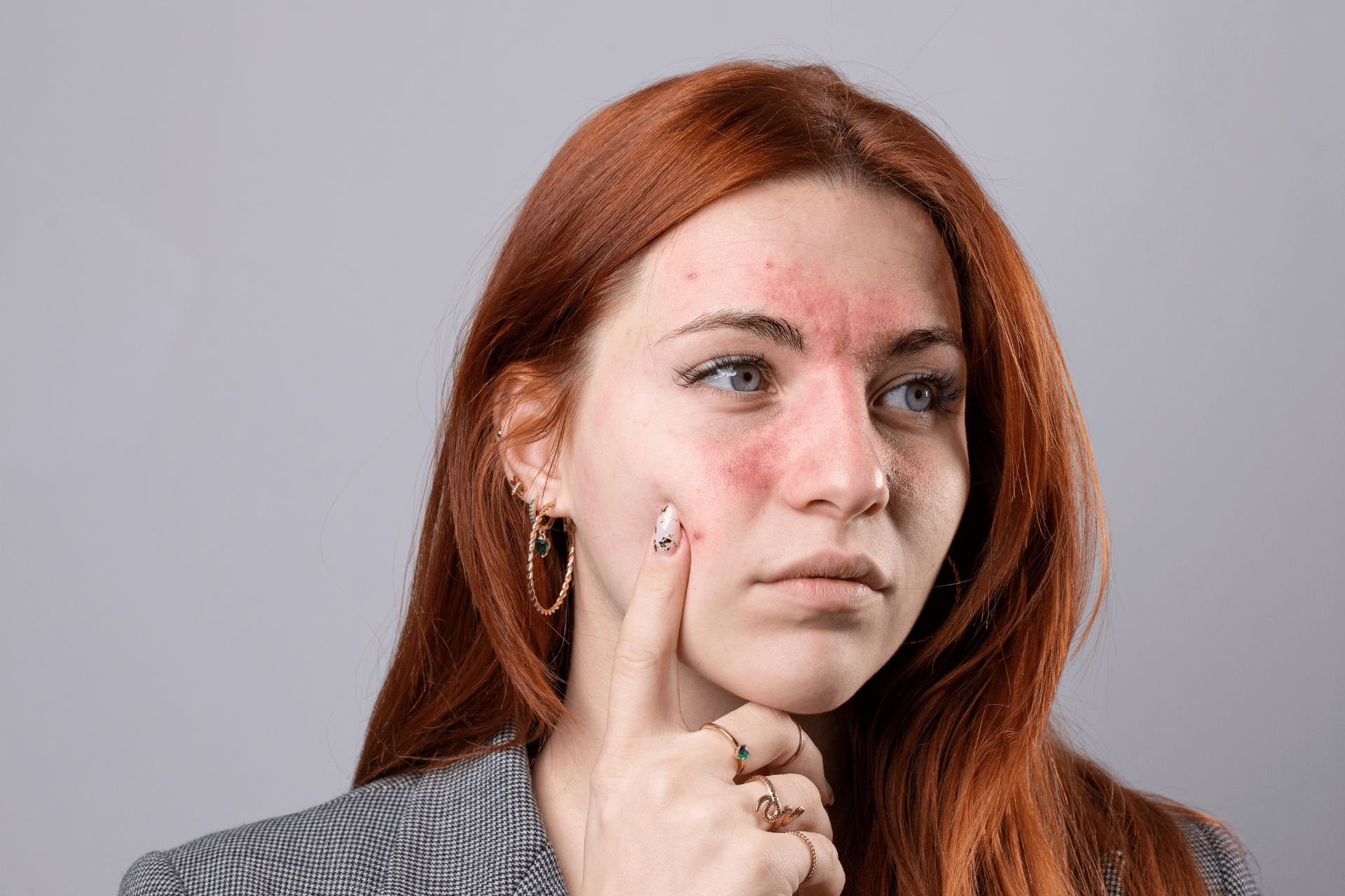 Woman with reddish, irritated skin on her face touching her cheek.
