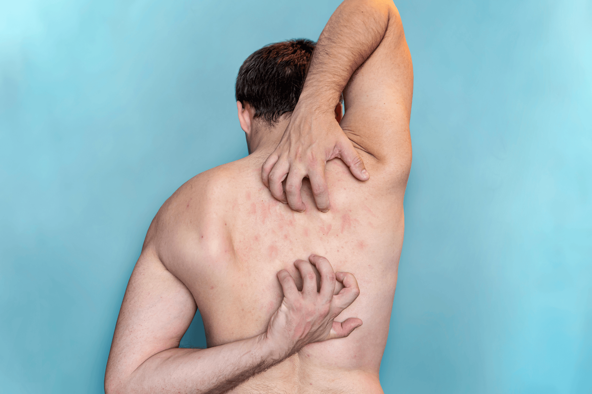 Man scratching his back, showing red irritated bumps consistent with scabies.