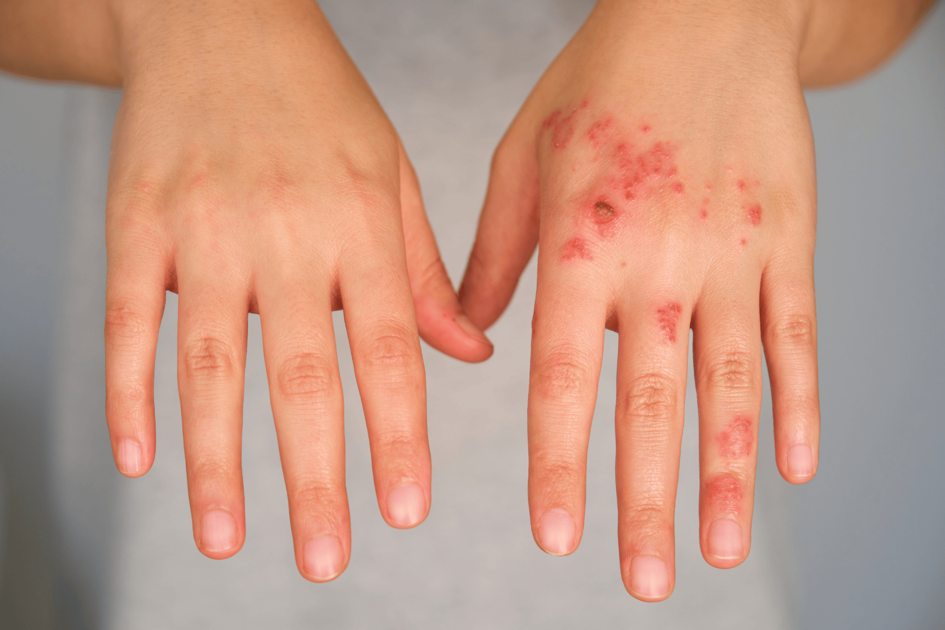 Hands showing red, irritated eczema patches on the skin.