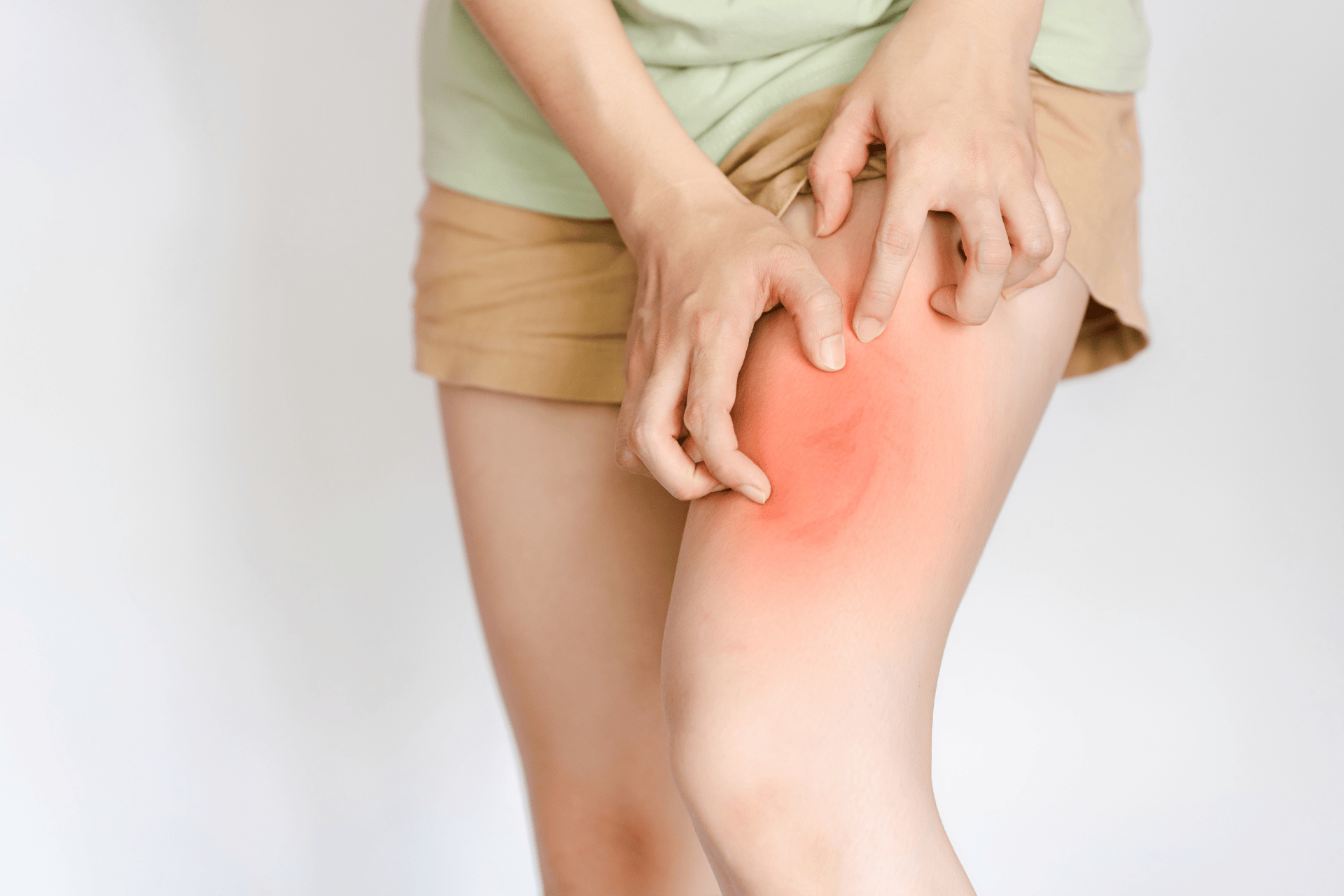 Person scratching a red, circular rash on their thigh, consistent with ringworm.