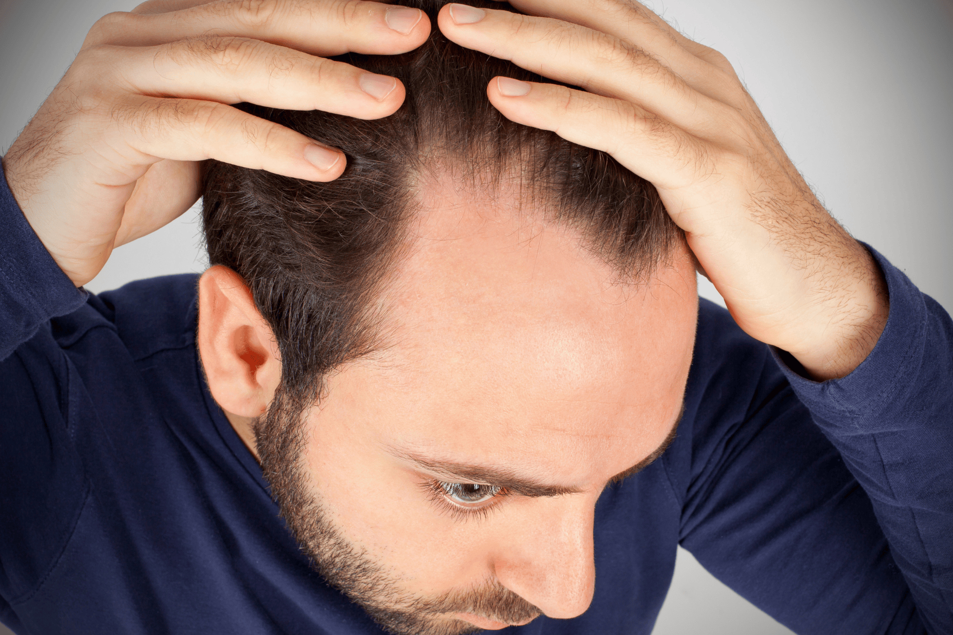 A man looks down while holding his hair back with both hands, revealing noticeable thinning and recession at the front of his scalp, indicating hair loss.