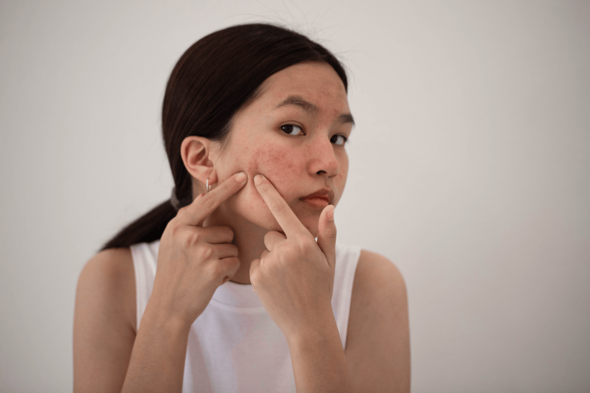 Young woman examining red, acne-prone skin on her cheek with her fingers.