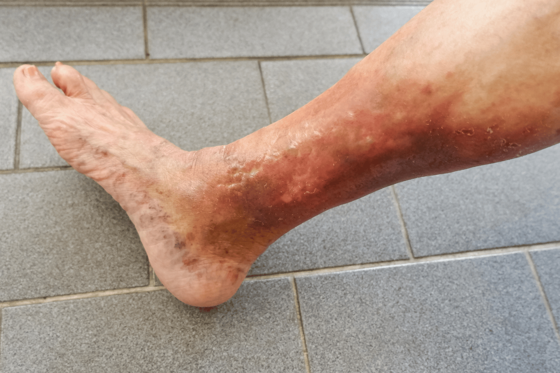 Lower leg and foot with reddish, inflamed, and discolored skin showing signs consistent with stasis dermatitis.